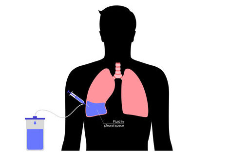 PLEURAL TAPPING PLEURAL TAPPING